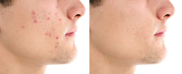 acne free face of a man after treatment