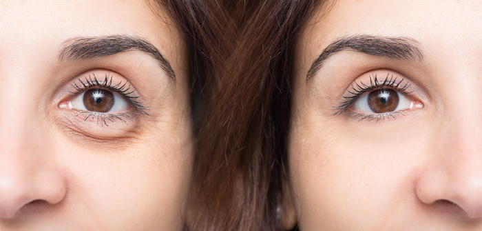 Woman eye before and after under eye treatment